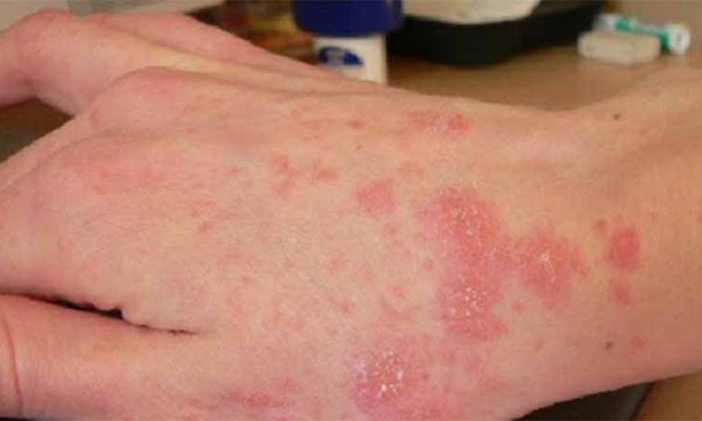 Thuốc Fluconazole trị nấm Candida