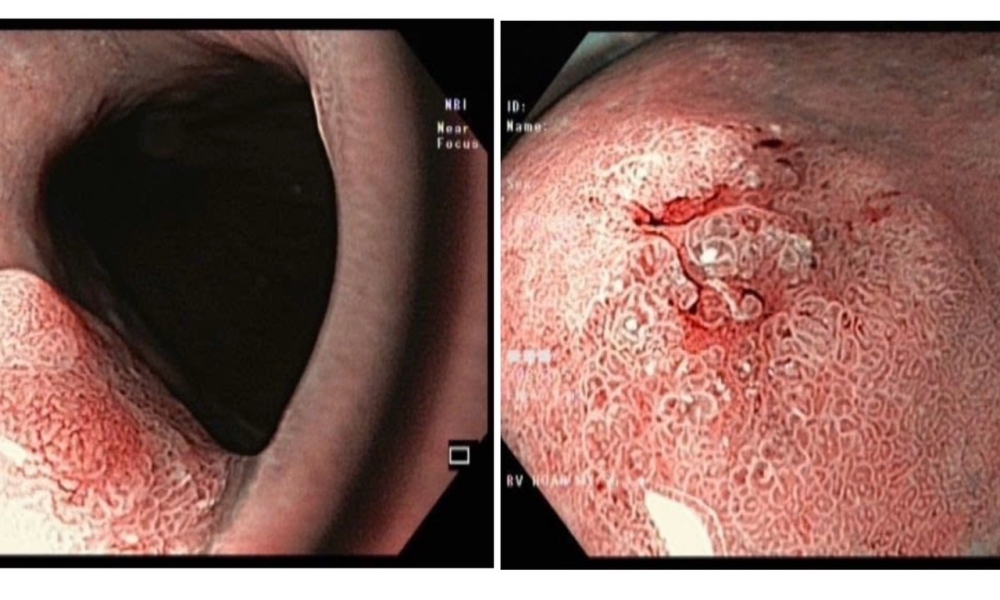 Kỹ thuật hiện đại giúp phát hiện sớm ung thư