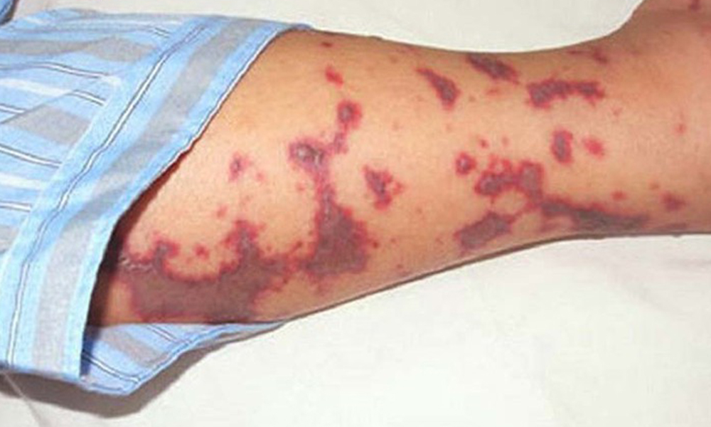 Cảnh báo bệnh não mô cầu đang gia tăng